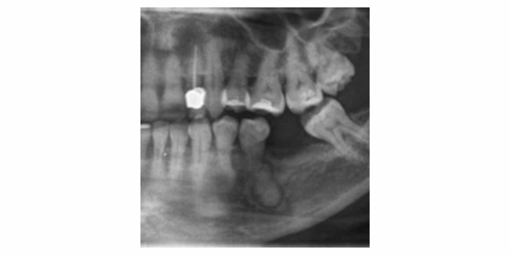 Displasia cemento-ósea focal