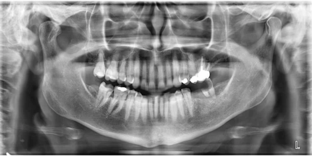 Torus mandibular