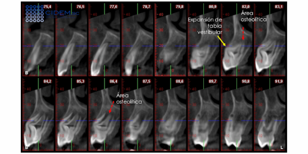 Dens invaginatus en canino superior