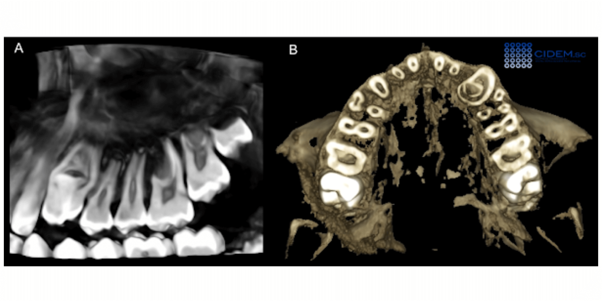 Dens invaginatus en canino superior - CIDEM, S.C.