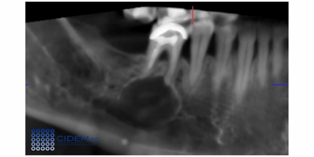 Quiste radicular asociado a molar inferior