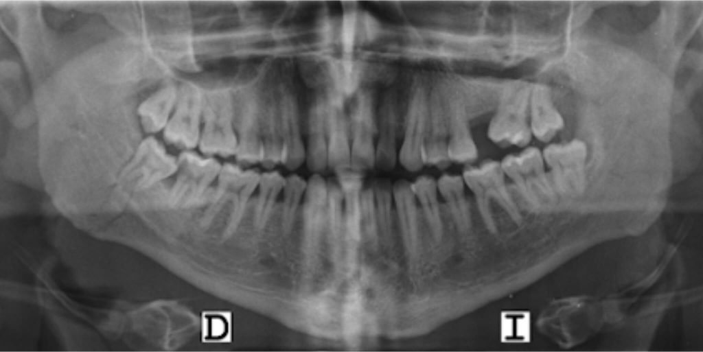 Fractura en ángulo derecho de la mandíbula