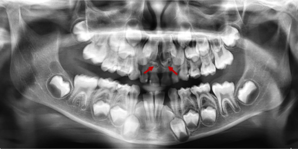 Mesiondens bilateral